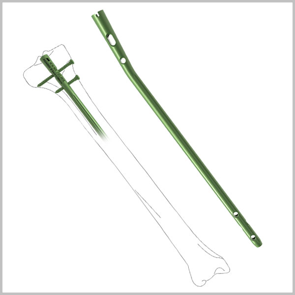 Tibia Interlocking Nail