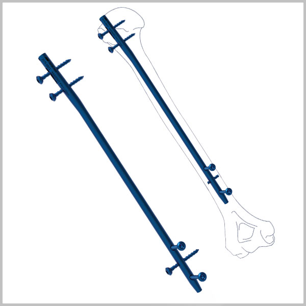 Humeral Interlocking Nail