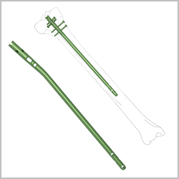 Expert Tibial Interlocking Nail