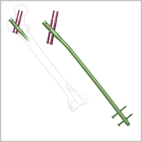 Proximal Femoral Nail (Long)